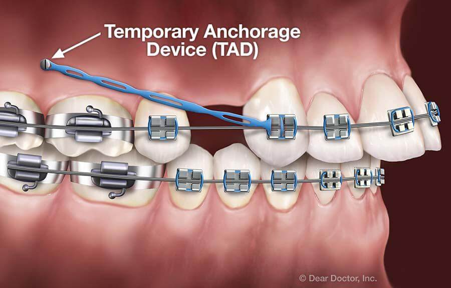 Orthodontic implant(TAD)